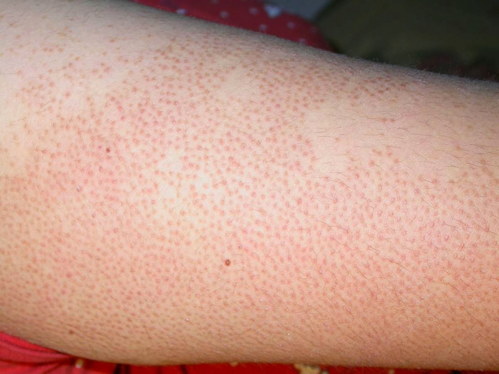 Điểm danh những bệnh ngoài da vào mùa hè bạn cần phòng ngừa