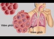 ✅✅ 4 mẫu lập kế hoạch chăm sóc bệnh nhân viêm phổi ✭★★