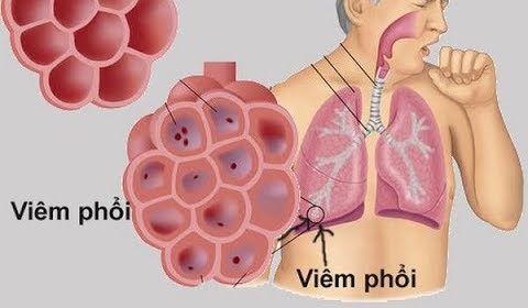 ✅✅ 4 mẫu lập kế hoạch chăm sóc bệnh nhân viêm phổi ✭★★