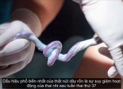 Dây rốn thắt nút, nguy hiểm cho mẹ và bé