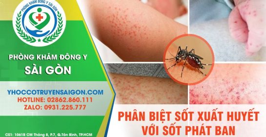 Phân Biệt Sốt Xuất Huyết Và Sốt Phát Ban Ở Trẻ Và Cách Xử Lý