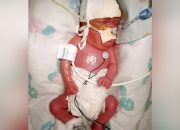 Em bé sinh non 15 tuần, nặng chưa tới 1kg sống sót thần kỳ dù mắc Covid-19 | VTC14