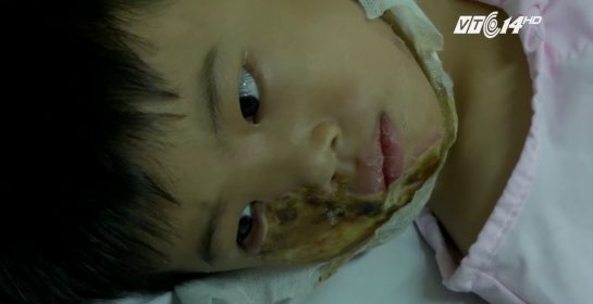 (VTC14)_Tình hình sức khỏe bé 5 tuổi bị bỏng điện ở TP HCM